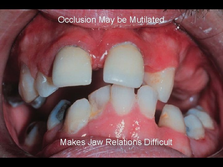 Occlusion May be Mutilated Makes Jaw Relations Difficult 