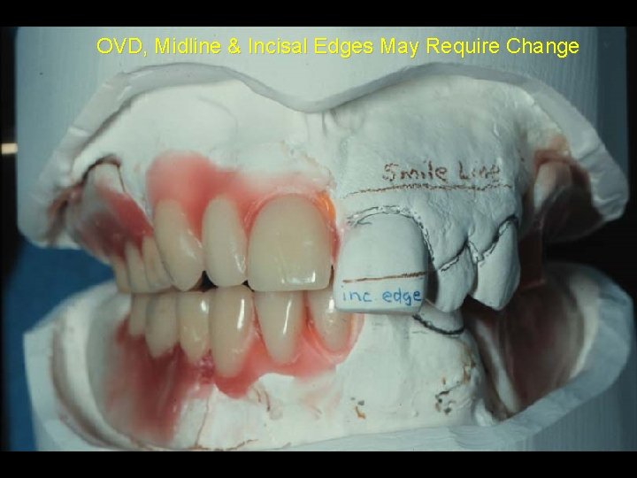 Immediate Dentures Complete or removable partial denture fabricated