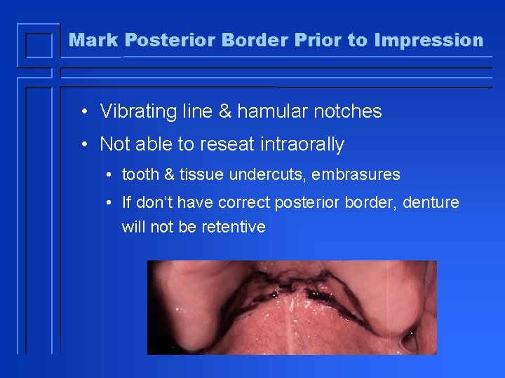 Mark Posterior Border Prior to Impression • Vibrating line & hamular notches • Not