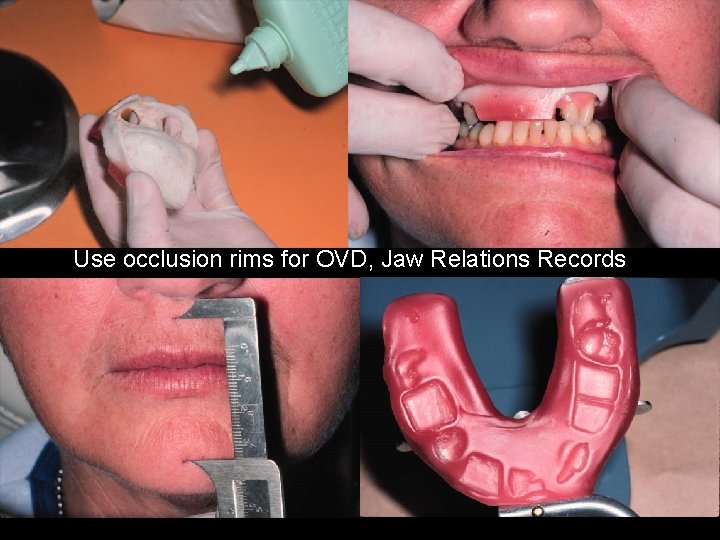 Use occlusion rims for OVD, Jaw Relations Records 