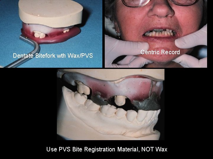 Dentate Bitefork wth Wax/PVS Centric Record Use PVS Bite Registration Material, NOT Wax 