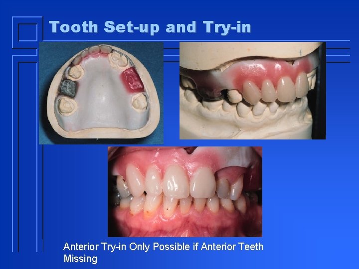 Tooth Set-up and Try-in Anterior Try-in Only Possible if Anterior Teeth Missing 