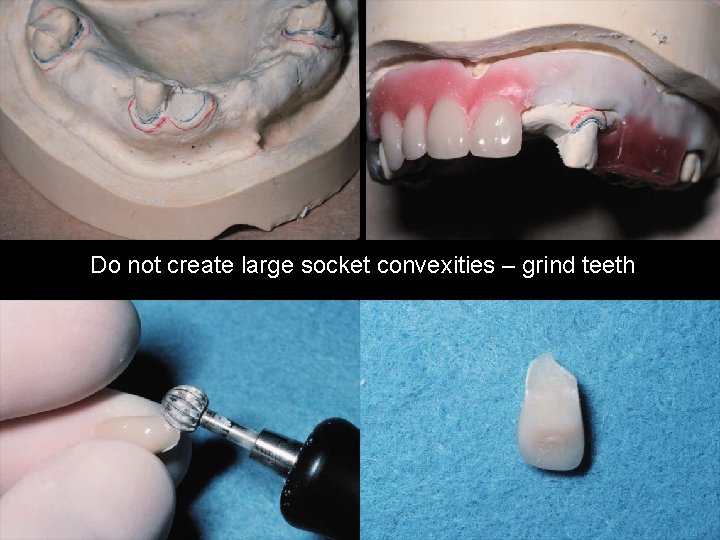 Do not create large socket convexities – grind teeth 