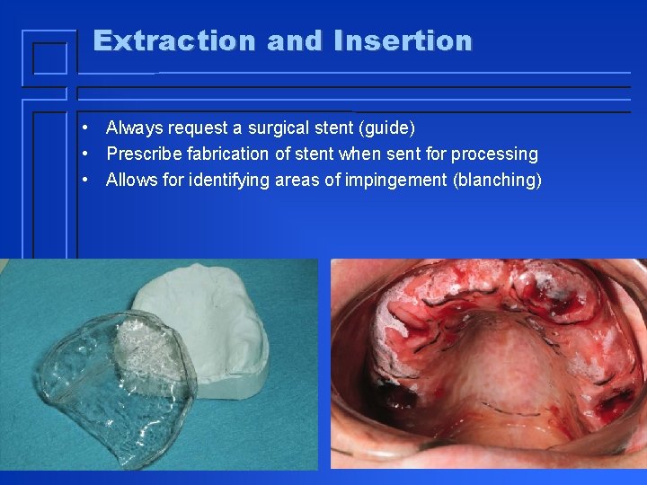 Extraction and Insertion • Always request a surgical stent (guide) • Prescribe fabrication of