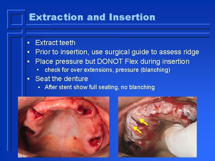 Extraction and Insertion • Extract teeth • Prior to insertion, use surgical guide to