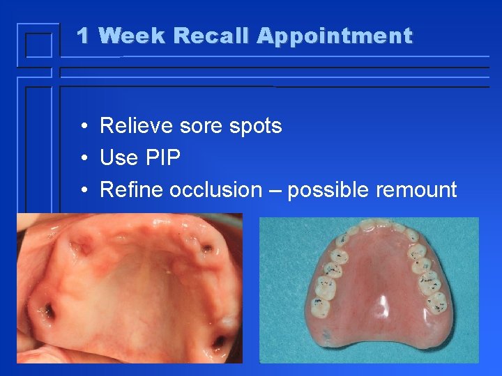 1 Week Recall Appointment • Relieve sore spots • Use PIP • Refine occlusion