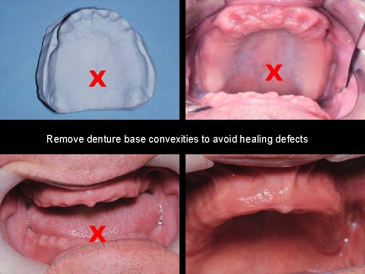 X X Remove denture base convexities to avoid healing defects X 