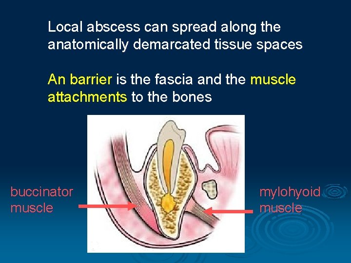 Local abscess can spread along the anatomically demarcated tissue spaces An barrier is the