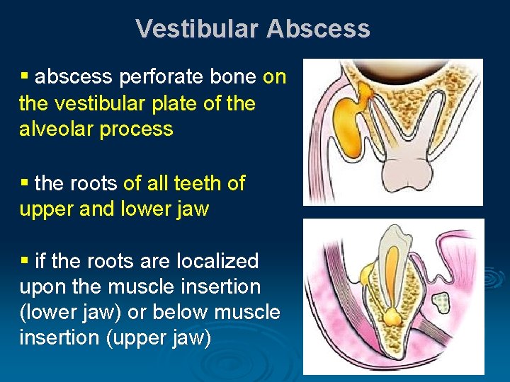 Vestibular Abscess § abscess perforate bone on the vestibular plate of the alveolar process