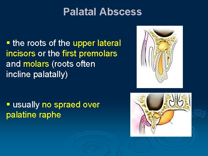 Palatal Abscess § the roots of the upper lateral incisors or the first premolars