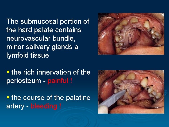 The submucosal portion of the hard palate contains neurovascular bundle, minor salivary glands a