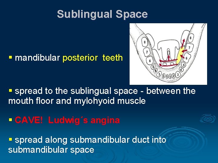 Sublingual Space § mandibular posterior teeth § spread to the sublingual space - between