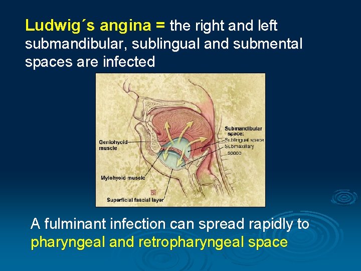 Ludwig´s angina = the right and left submandibular, sublingual and submental spaces are infected