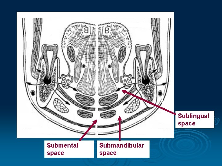 Sublingual space Submental space Submandibular space 