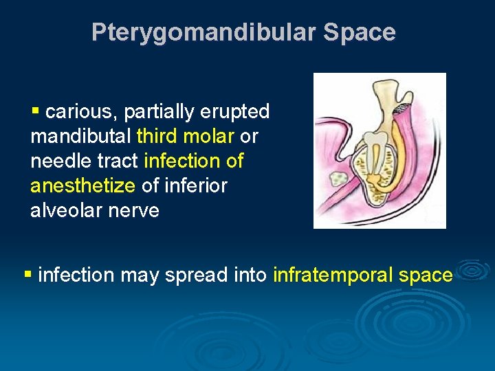 Pterygomandibular Space § carious, partially erupted mandibutal third molar or needle tract infection of