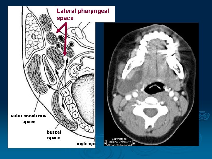 Lateral pharyngeal space 