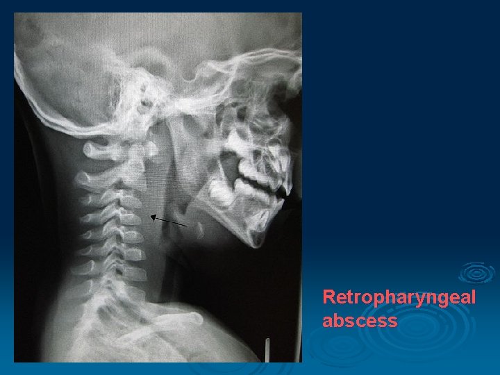 Retropharyngeal abscess 