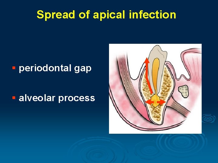 Spread of apical infection § periodontal gap § alveolar process 