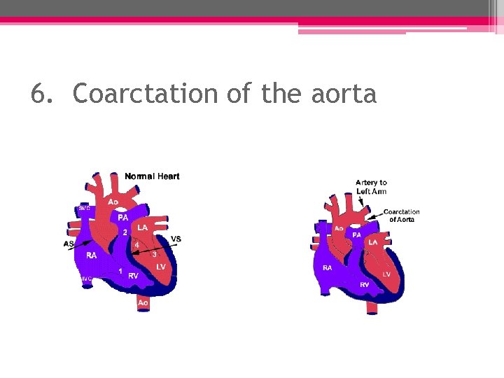 6. Coarctation of the aorta 