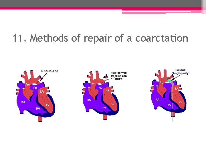 11. Methods of repair of a coarctation 