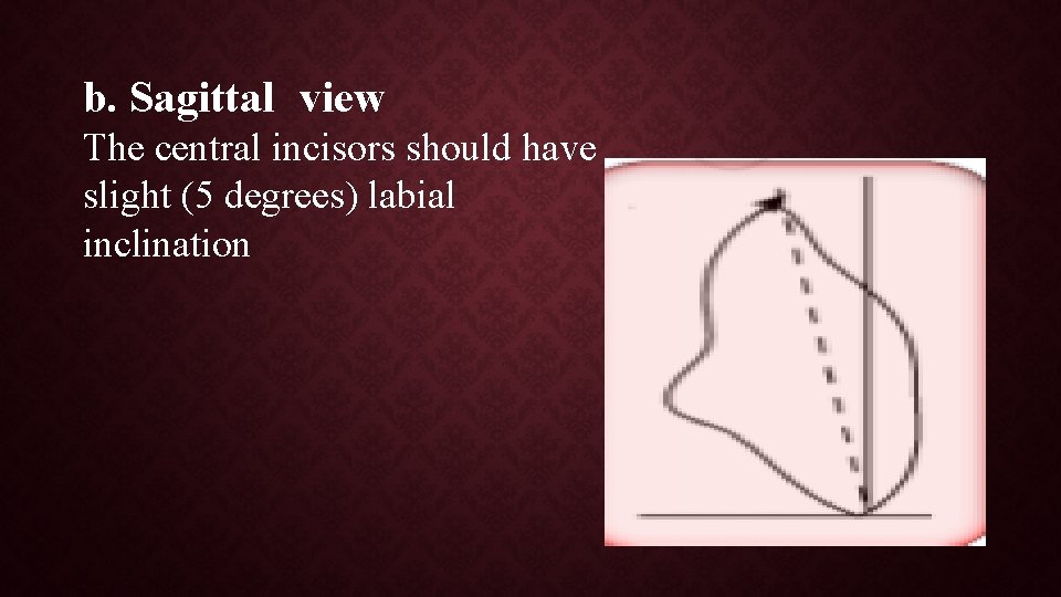 b. Sagittal view The central incisors should have slight (5 degrees) labial inclination 