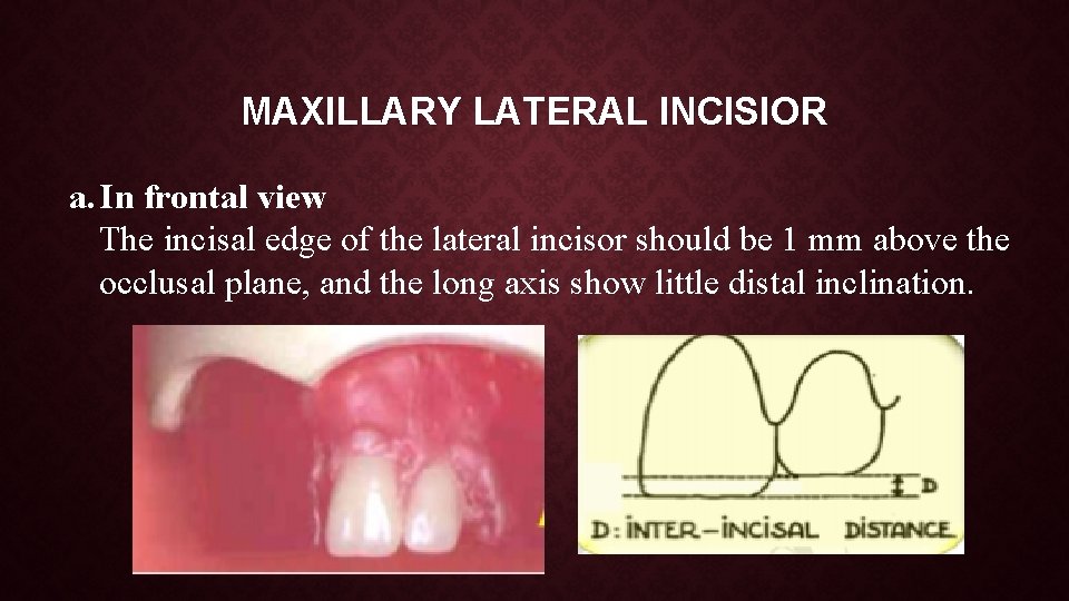 MAXILLARY LATERAL INCISIOR a. In frontal view The incisal edge of the lateral incisor