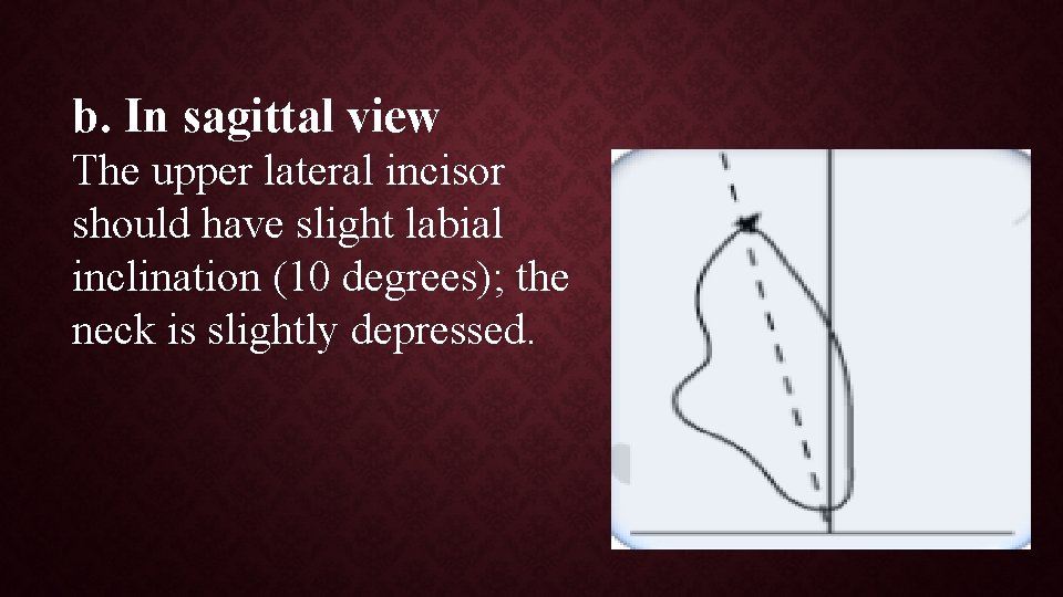 b. In sagittal view The upper lateral incisor should have slight labial inclination (10