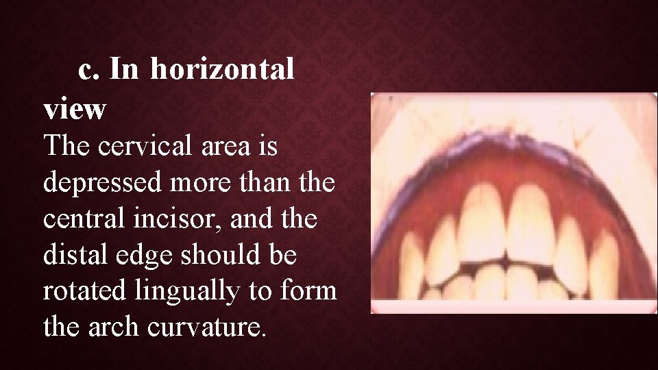 c. In horizontal view The cervical area is depressed more than the central incisor,