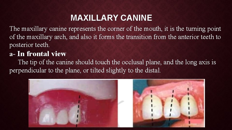 MAXILLARY CANINE The maxillary canine represents the corner of the mouth, it is the