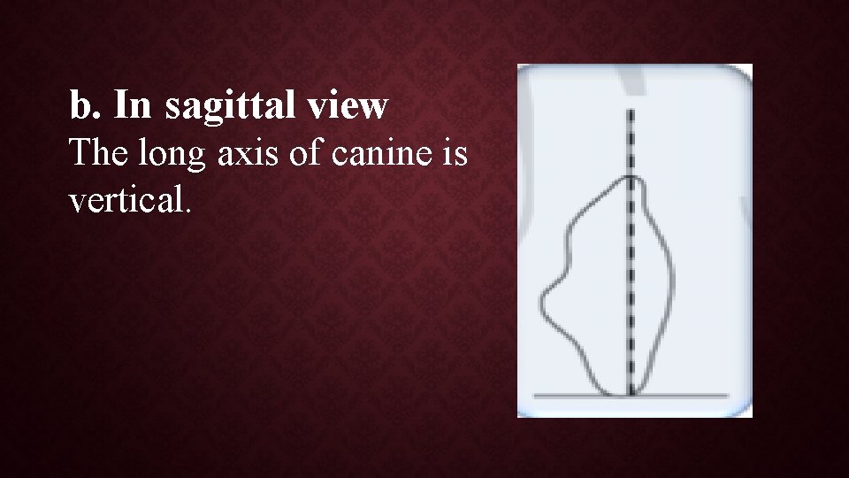 b. In sagittal view The long axis of canine is vertical. 