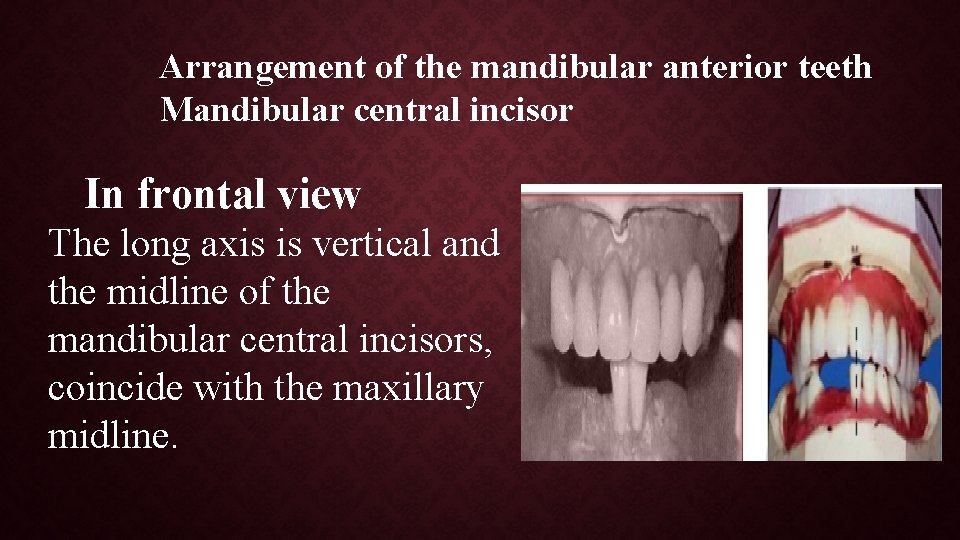 Arrangement of the mandibular anterior teeth Mandibular central incisor In frontal view The long