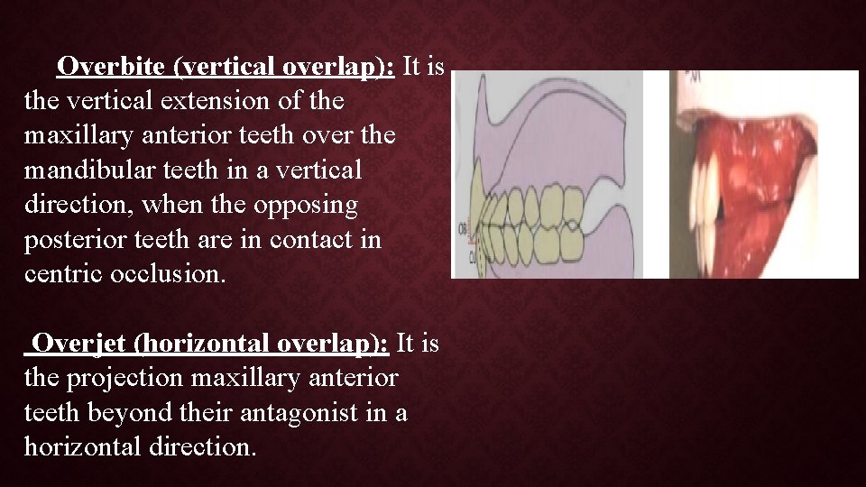 Overbite (vertical overlap): It is the vertical extension of the maxillary anterior teeth over