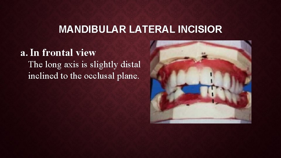 MANDIBULAR LATERAL INCISIOR a. In frontal view The long axis is slightly distal inclined