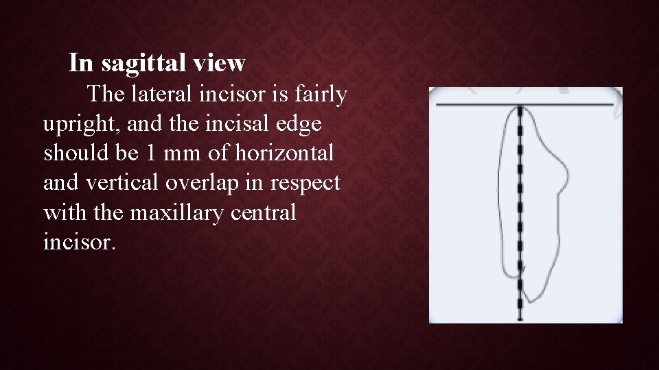 In sagittal view The lateral incisor is fairly upright, and the incisal edge should