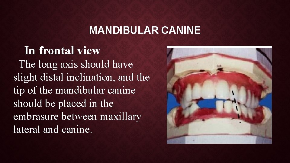 MANDIBULAR CANINE In frontal view The long axis should have slight distal inclination, and