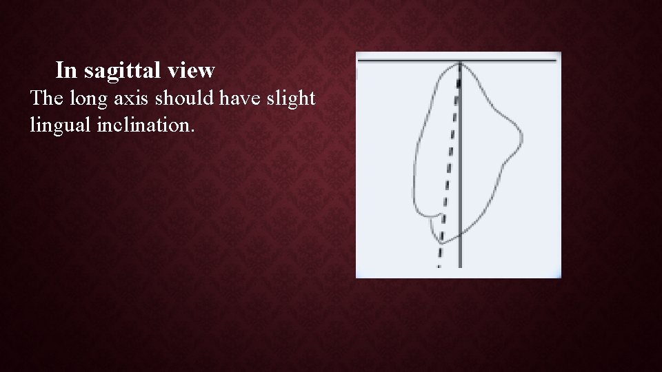 In sagittal view The long axis should have slight lingual inclination. 