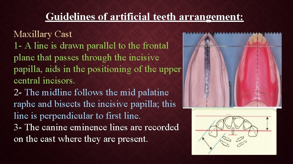 Guidelines of artificial teeth arrangement: Maxillary Cast 1 - A line is drawn parallel