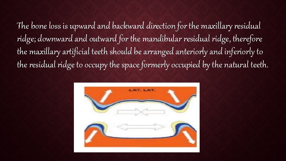 The bone loss is upward and backward direction for the maxillary residual ridge; downward