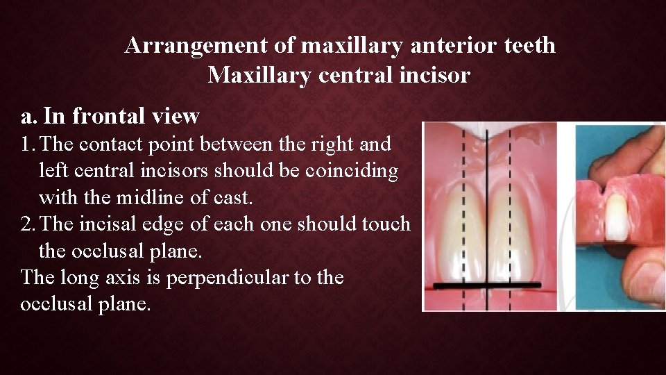 Arrangement of maxillary anterior teeth Maxillary central incisor a. In frontal view 1. The