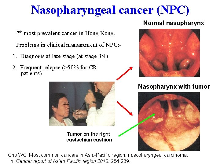 Nasopharyngeal cancer (NPC) Normal nasopharynx • 7 th most prevalent cancer in Hong Kong.