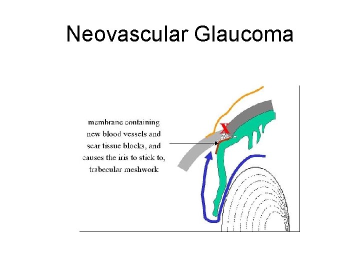 Neovascular Glaucoma 