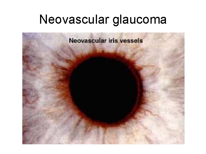 Neovascular glaucoma Neovascular glaucoma
