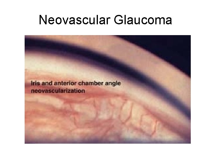 Neovascular Glaucoma 