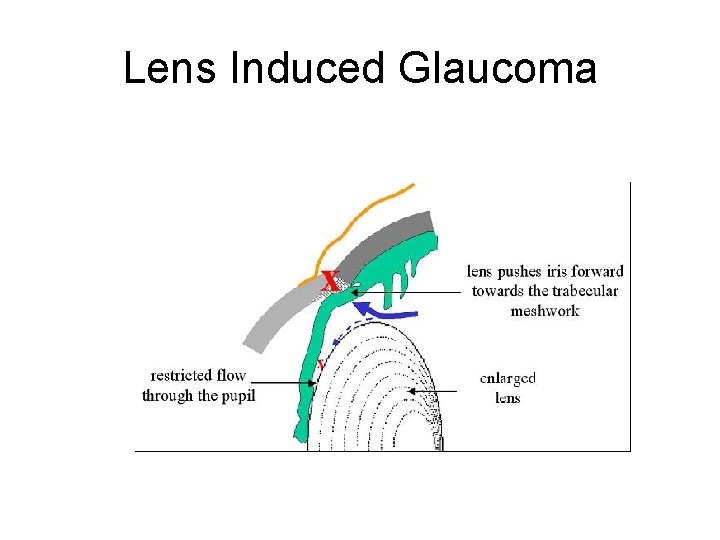 Lens Induced Glaucoma 