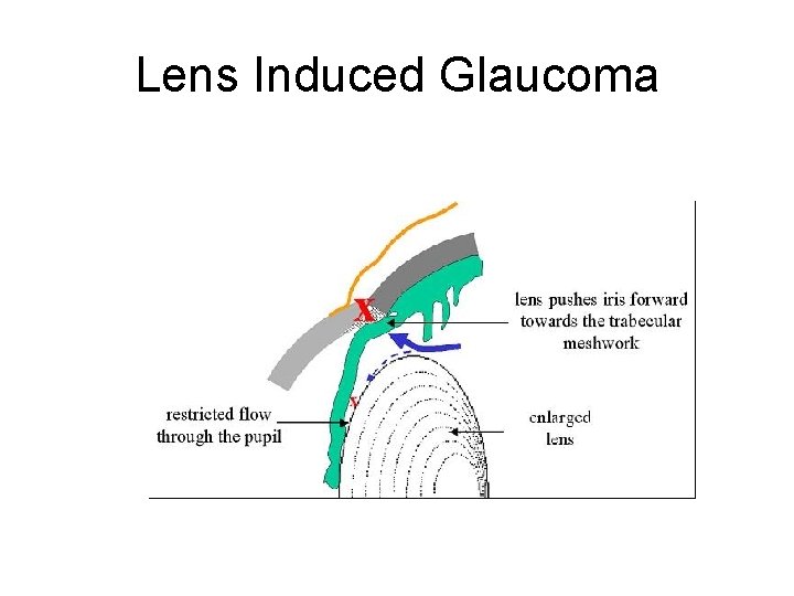 Lens Induced Glaucoma Lens Induced Glaucoma