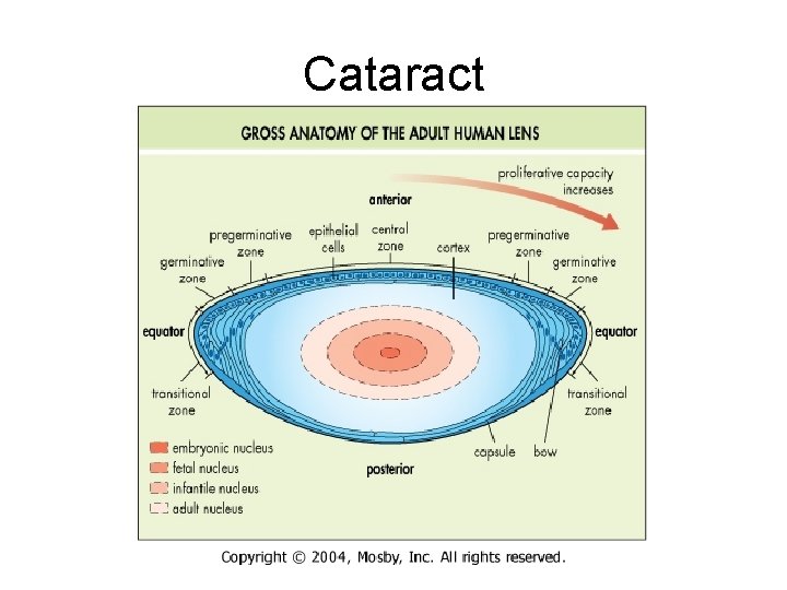 Cataract Cataract