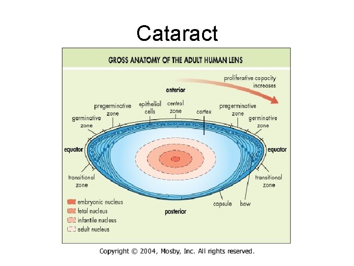 Cataract 