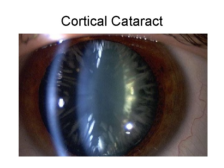 Cortical Cataract Cortical Cataract
