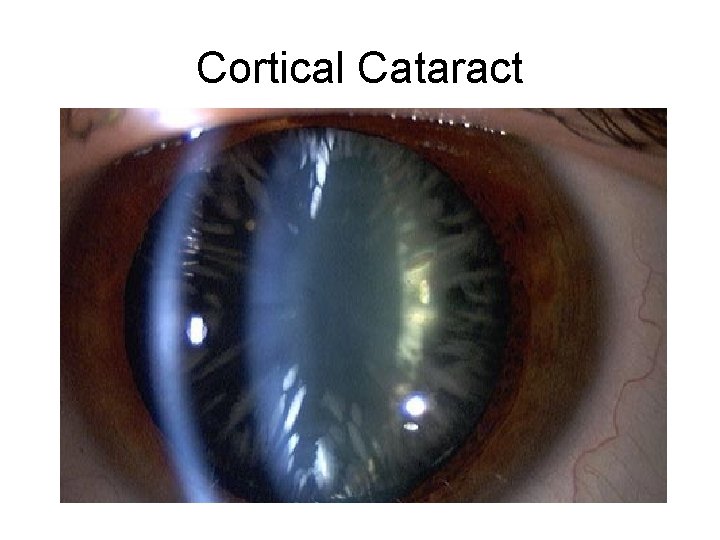 Cortical Cataract 