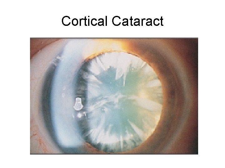 Cortical Cataract Cortical Cataract